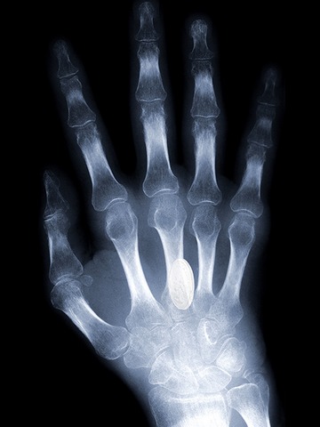 X-rays