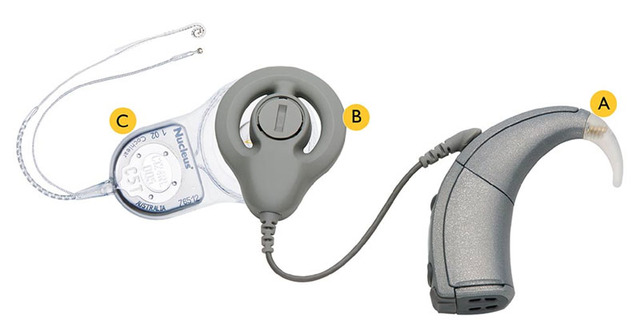 Cochlear Implant