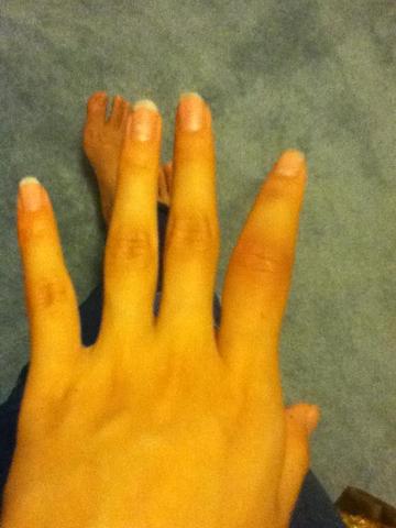 Sprained my Finger in Basketball