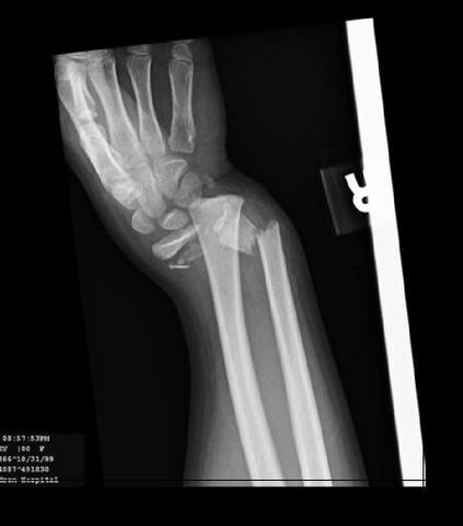 I broke my wrist.