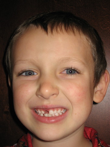 I lost my 1st tooth