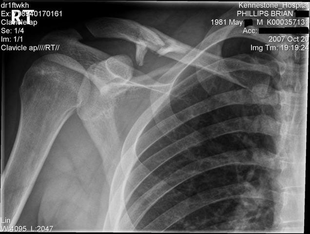 i broke my right collarbone