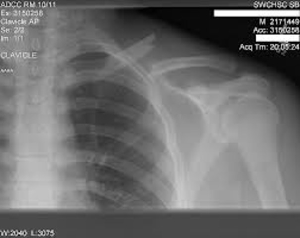 Broke My Collar Bone.