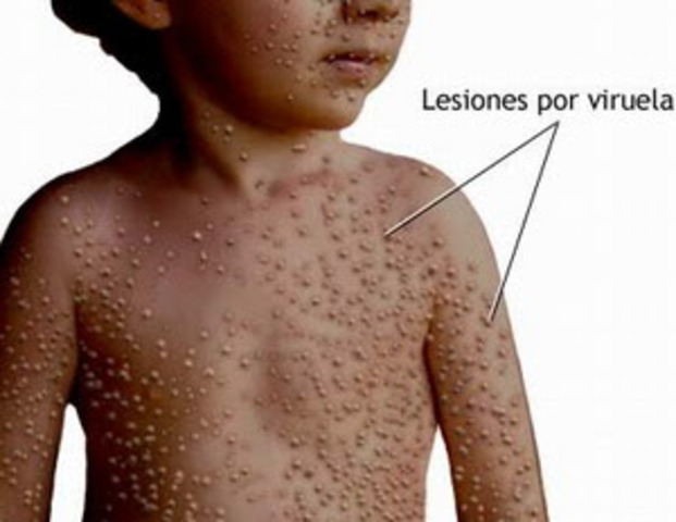 La cura para la viruela