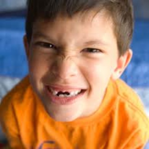 I knocked my front teeth out