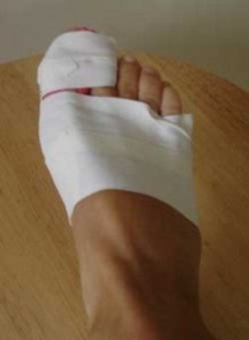 Broken toe