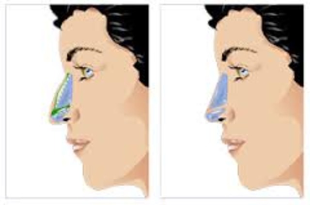 Rhinoplastie