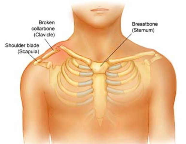 Broke my clavicle