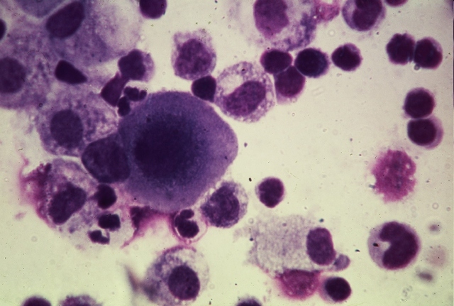 Stem Cell Link to Cancer