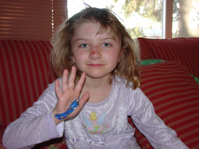 Broke Nose - Second Time