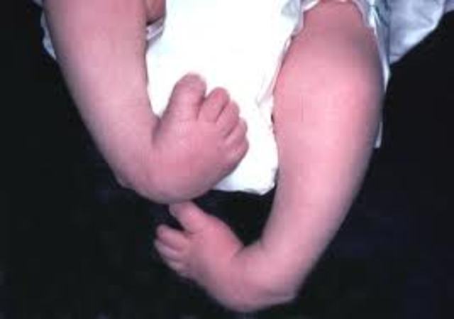 Club Foot