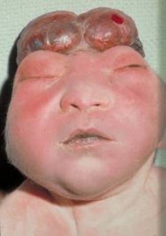 Anencephaly