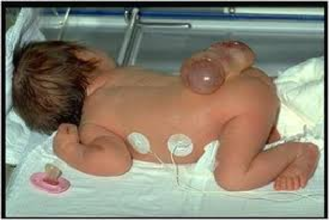 Neural Tube Defect