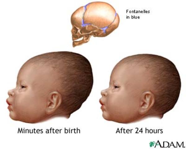 PKU birth defect