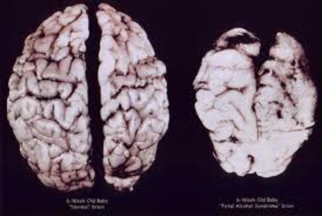 26 Weeks (HIGH RISK FOR BRAIN DAMAGE)