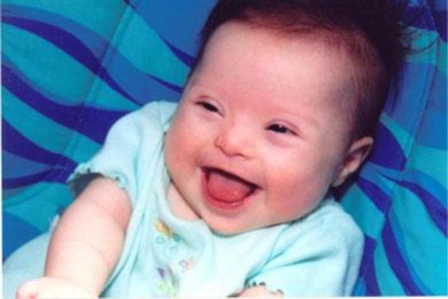 Down syndrom birth defect