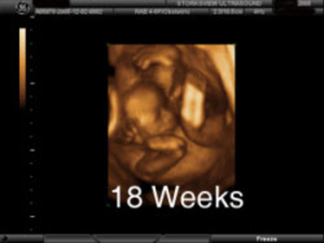 18 Weeks