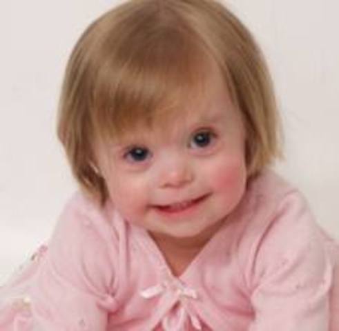 Down Syndrome