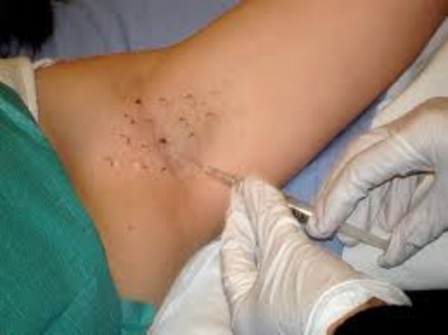 Aprroved for Hyperhidrosis