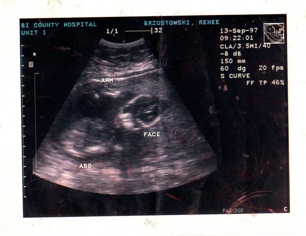 Mom gets altrosound done