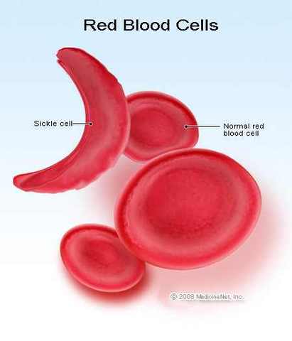 Sickle Cell