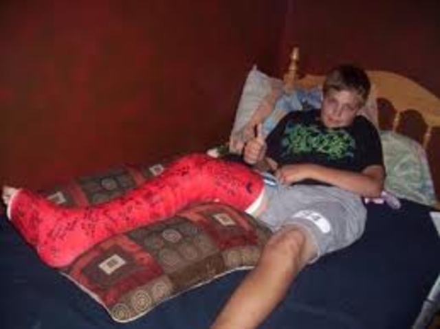 I Broke my Leg