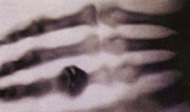 William Roentgen Discovered X-rays