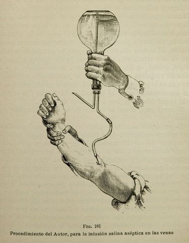 Se practica por primera vez la cirugia antiseptica