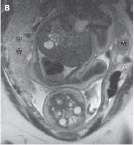 The First Hysterectomy