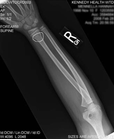 Broken Wrist
