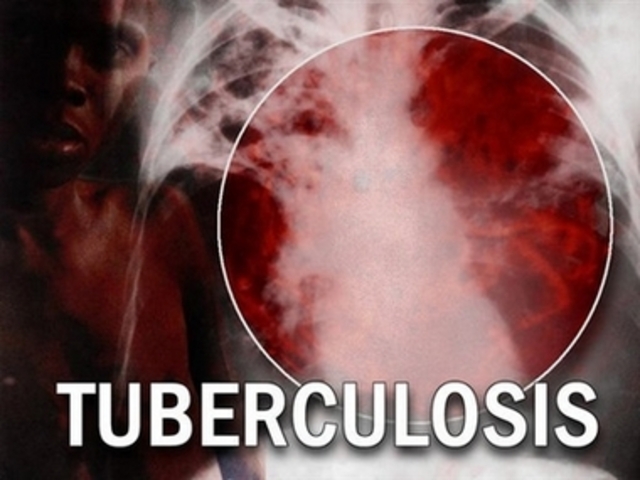 Vigotsky contrae tuberculosis