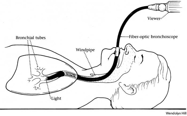 First Bronchoscopy
