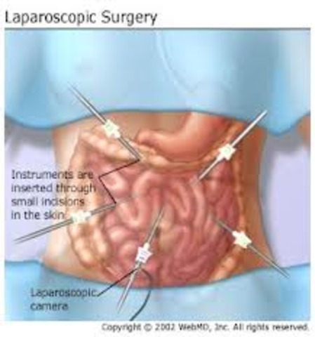 Advances in laparoscopic surgery