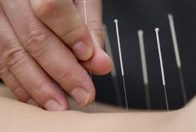 Chinese used Acupuncture to Relieve Pain and Congestion