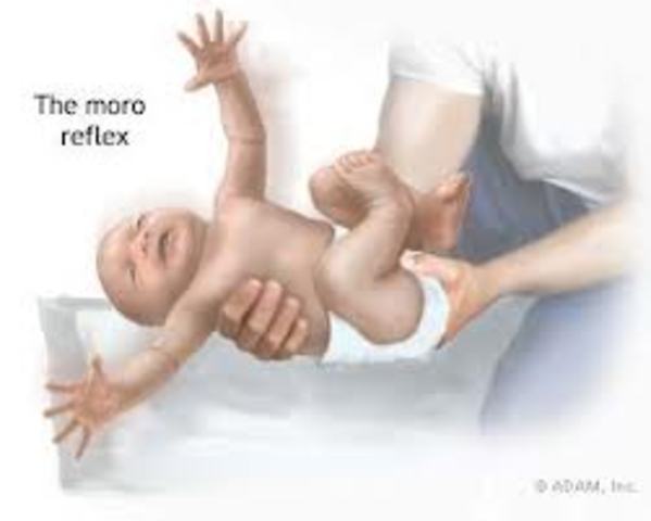 Moro Reflex (Startle Reflex)