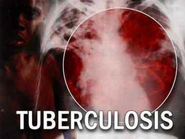 TUBERCULOSIS: KOCH´S TESTS FAIL