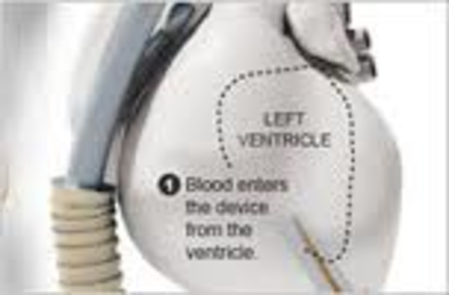 Succesful Heart Implant