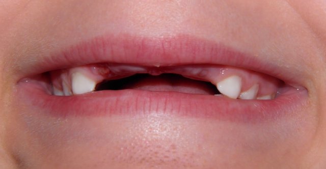 When i lost my tooth