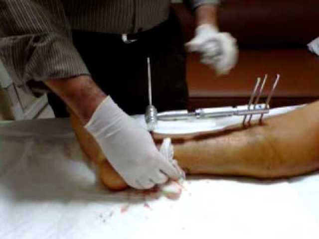 mi madre se rompe una pierna