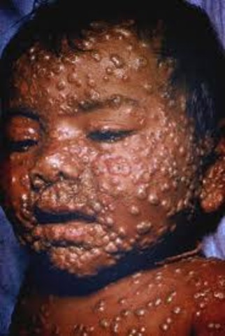 Smallpox epidemic in India
