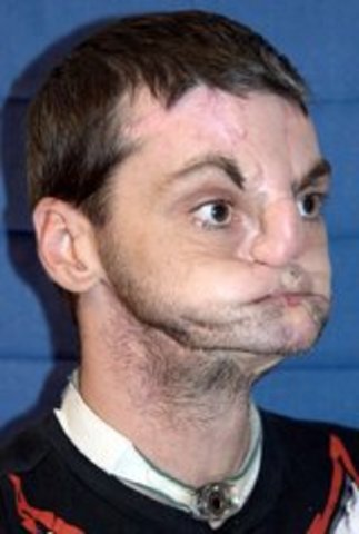 Laurent Lantieri performs the first full face transplant