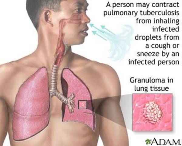 First vaccine developed for tuberculosis