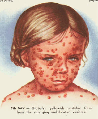 Small Pox
