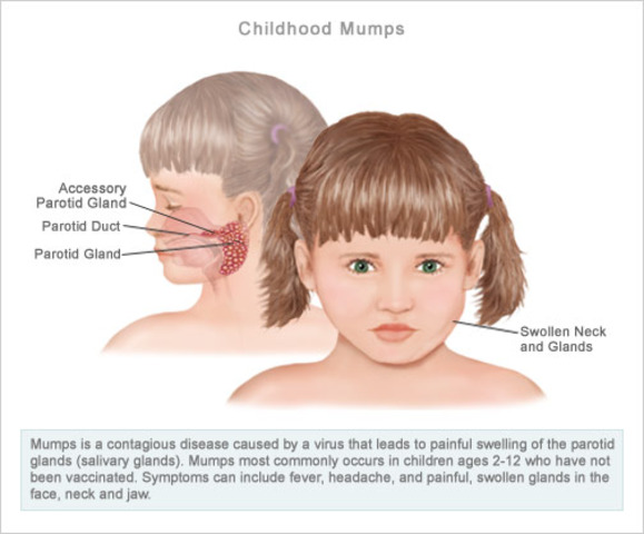 First vaccine developed for mumps