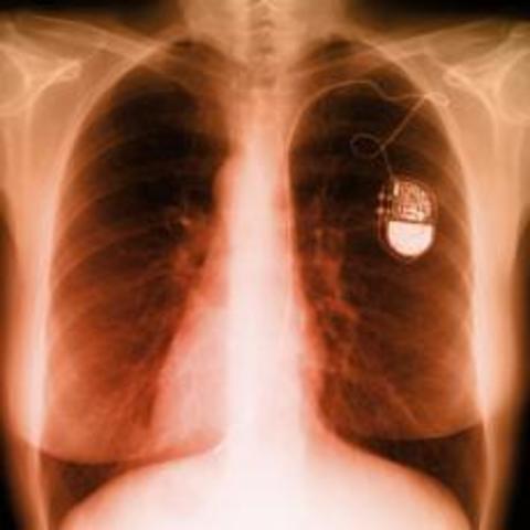 cardiac pacemaker.