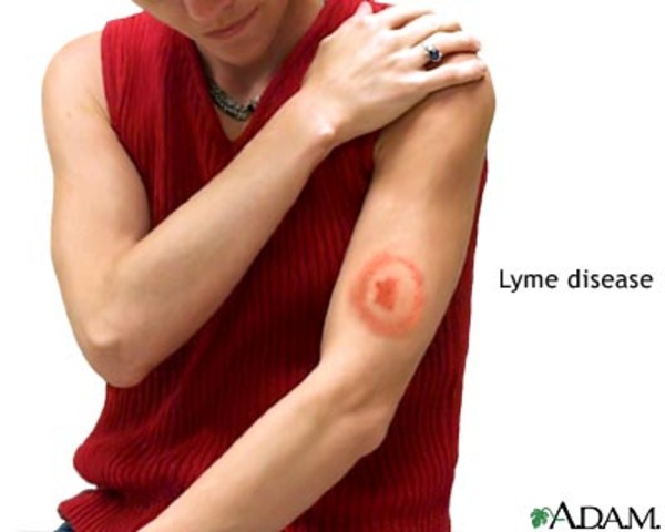 First vaccine for lyme disease