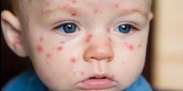 Chickenpox vaccine