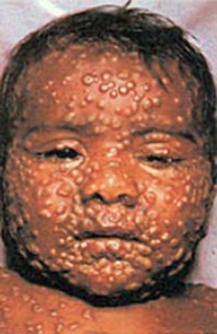 Smallpox is eradicated