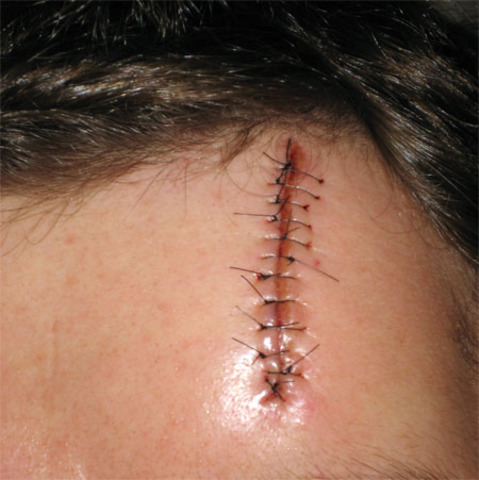 The day i cracked my head open