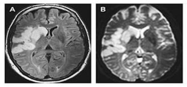 First Therapy for Ischemic Stroke